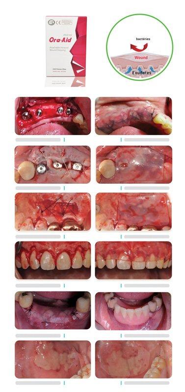 34f9a37355786712acb27ba66c04474e_a8212b95-48b8-40a5-b4d2-e8653ab5bf53-1 Pack Bond Apatite™, Matbeka™ et fils de suture - Safe Implant